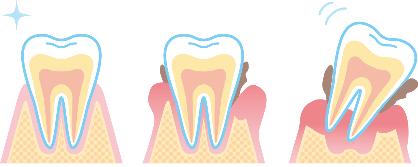 歯周病は、デンタルバイオフィルムと言う細菌の塊が、 歯と歯肉の境目にたまることから発症します。